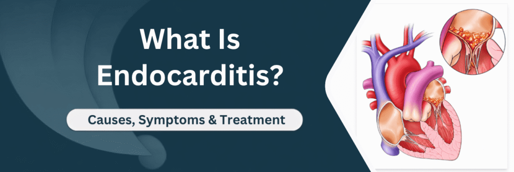 What Is Endocarditis? Causes, Symptoms & Treatment